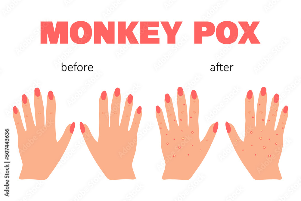 Banner with smallpox monkey. Monkey pox. Hands with a rash. Smallpox symptom. Vector illustration. Banner with smallpox monkey. Monkey pox. Hands with a rash. Smallpox symptom. Vector illustration.