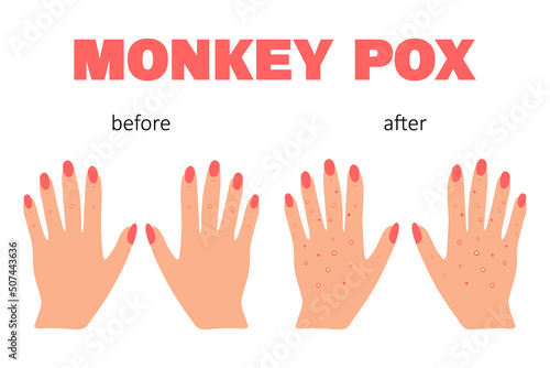 Banner with smallpox monkey. Monkey pox. Hands with a rash. Smallpox symptom. Vector illustration.