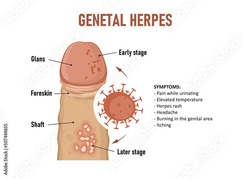 Genital herpes. Herpes simplex virus photo