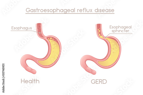 Human Stomach with gastroesophageal reflux disease cartoon design human anatomy organ vector illustration on white background