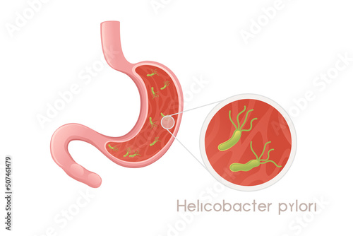 Human Stomach with helicobacter pylori cartoon design human anatomy organ vector illustration on white background photo