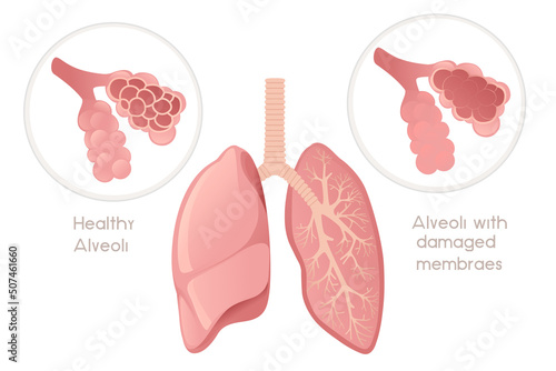 Human Lungs alveoli with damaged membrane cartoon design human anatomy organ vector illustration on white background