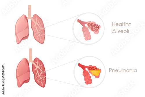 Human Lungs alveoli with pneumonia cartoon design human anatomy organ vector illustration on white background