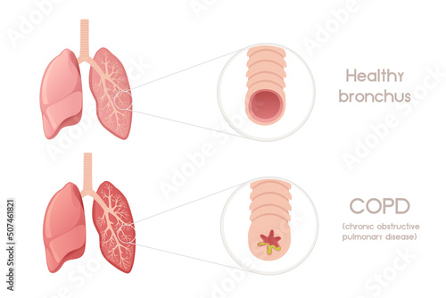 Human lungs bronchi with bronchitis cartoon design human anatomy organ vector illustration on white background