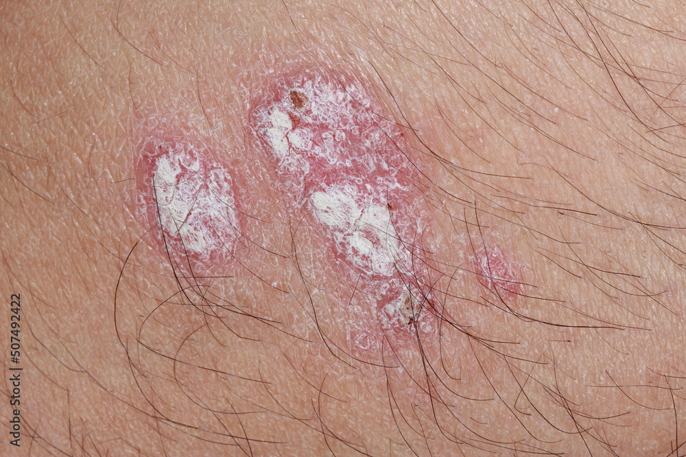 Fototapeta premium problem skin psoriasis on the body. Psoriasis is an autoimmune disease that affects the skin causing red, scaly skin inflammation.