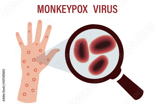 A hand with a lot of papules due to the pandemic outbreak of the monkey pox virus. Diagram of a virion cell under a magnifying glass. A rare disease from Africa. Vector illustration