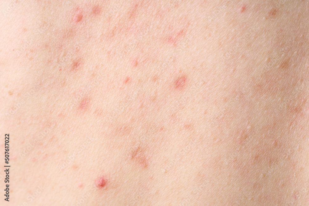 Skin with acne, with red spots. Health problem, skin diseases. Close up Allergy rash. Dermatitis problem of rash. 