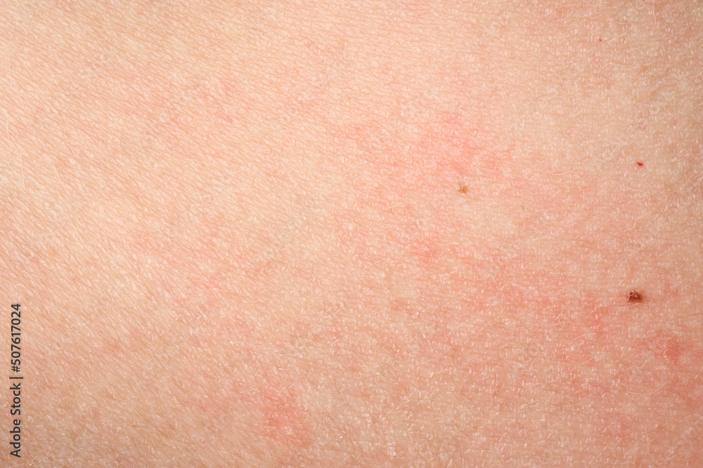 Skin with acne, with red spots. Health problem, skin diseases. Close up Allergy rash. Dermatitis problem of rash. 