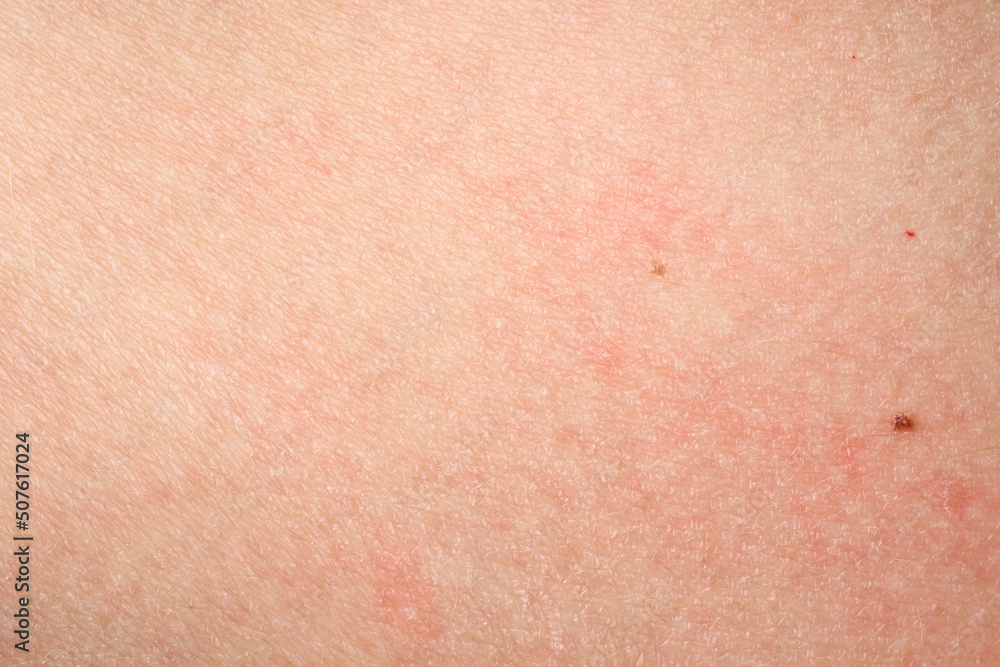 Skin with acne, with red spots. Health problem, skin diseases. Close up Allergy rash. Dermatitis problem of rash. Skin with acne, with red spots. Health problem, skin diseases. Close up Allergy rash. Dermatitis problem of rash.