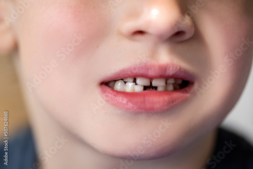 Preschool boy missing first baby tooth close up smile shot