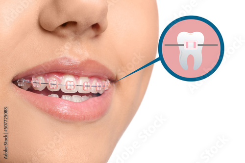 Young woman with dental bra...