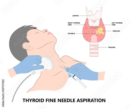Thyroid cancer disease nodules ultrasound screening check medical treat fine needle aspiration lumps test lab gland neck pain Graves FNA FNAB Large Toxic diagnostic exam collect lymph nodes cell