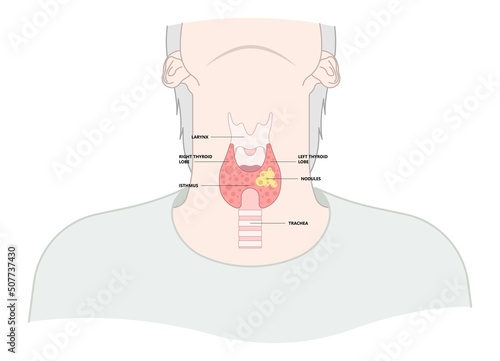 Thyroid cancer disease nodules ultrasound screening check medical treat fine needle aspiration lumps test lab gland neck pain Graves FNA FNAB Large Toxic diagnostic exam collect lymph nodes cell