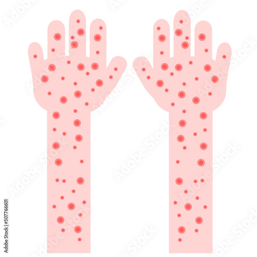Skin rash.Hands with skin problems concept isolated.Monkeypox or chickenpox virus.Measles symptom.Mosquitoes and insects bites.Food allergy.Itchy spots.Eczema and psoriasis.Vector illustation.