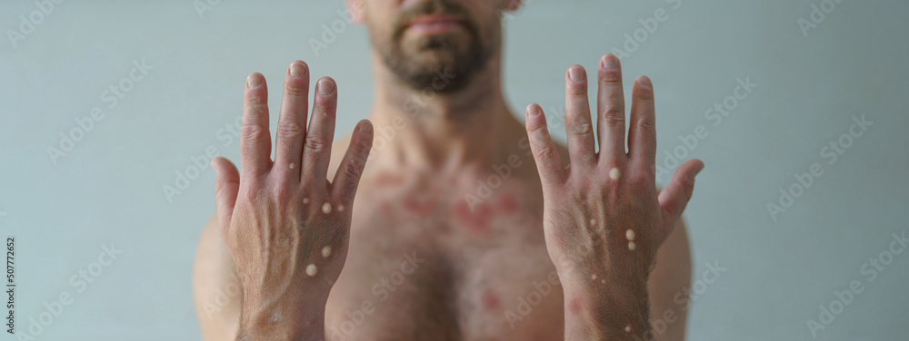 Male hands affected by blistering rash because of monkeypox or other viral infection on white background - obrazy, fototapety, plakaty 