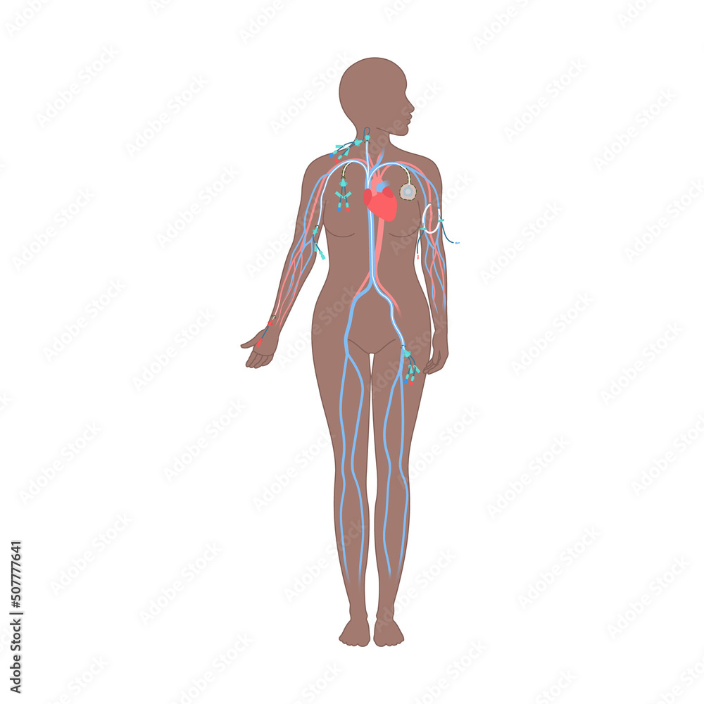Central venous catheter placement sites shown on the female body. Types