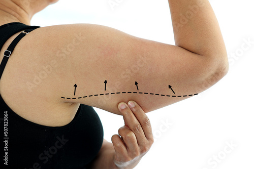 Plastic surgery doctor draw line on patient arm. Woman with excess fat on her upper arm with marks for liposuction or plastic surgery isolated on white, cosmetic surgery concept. 