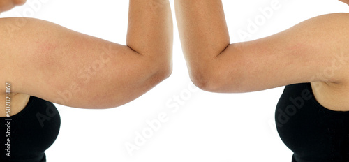 Comparison before and after Obesity Cellulite And Fat Removal liposuction Surgery on upper arm to get rid of sagging fat arm skin. Brachioplasty or Upper-Arm Lift plastic surgery in Asian woman. 
