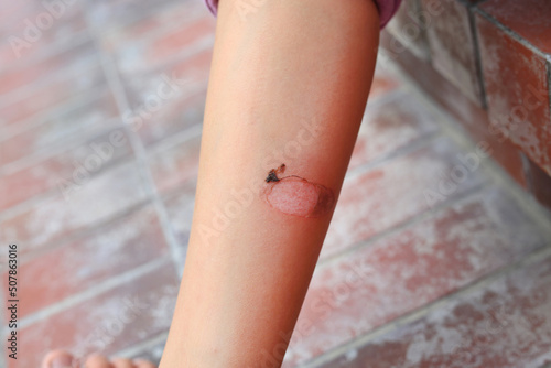 Obraz na plátně Kid Leg wounds caused by hot blanching from motorcycle exhaust pipes