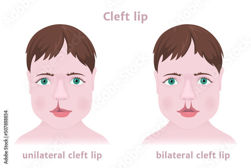 Congenital childhood pathology cleft lip. One-sided and two-sided. Realistic face. Medical poster. Vector illustration photo