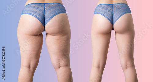 Fotografie, Obraz Overweight woman with fat cellulite legs and buttocks, before after weight loss
