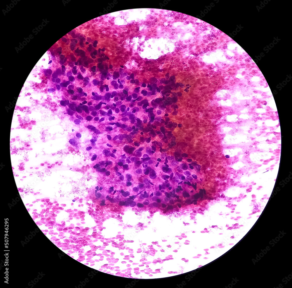 Elbow joint lesion(CT guided FNA) Tubercular arthritis, microscopic