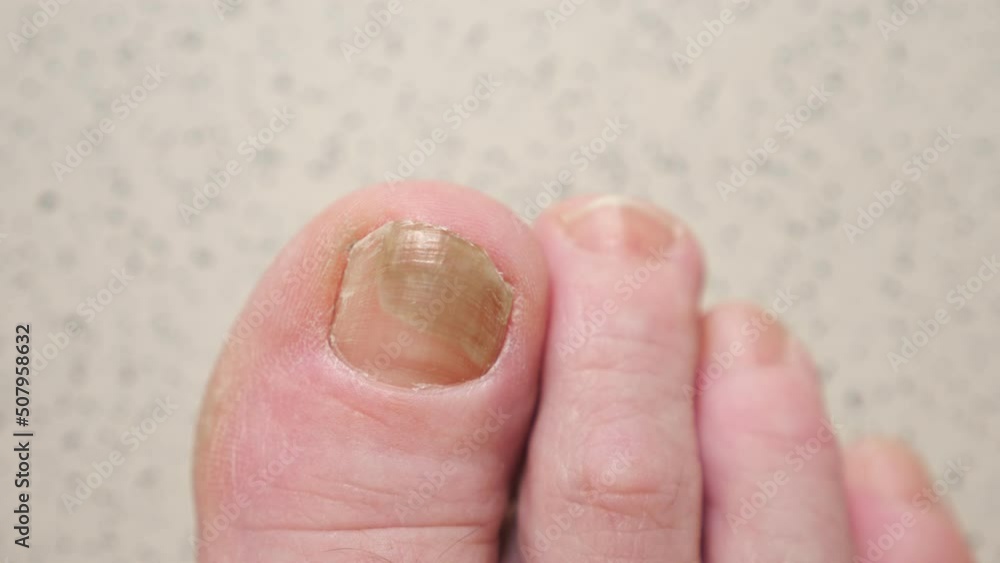 Toenails of woman with fungal infection. Brown bruise under nail of big