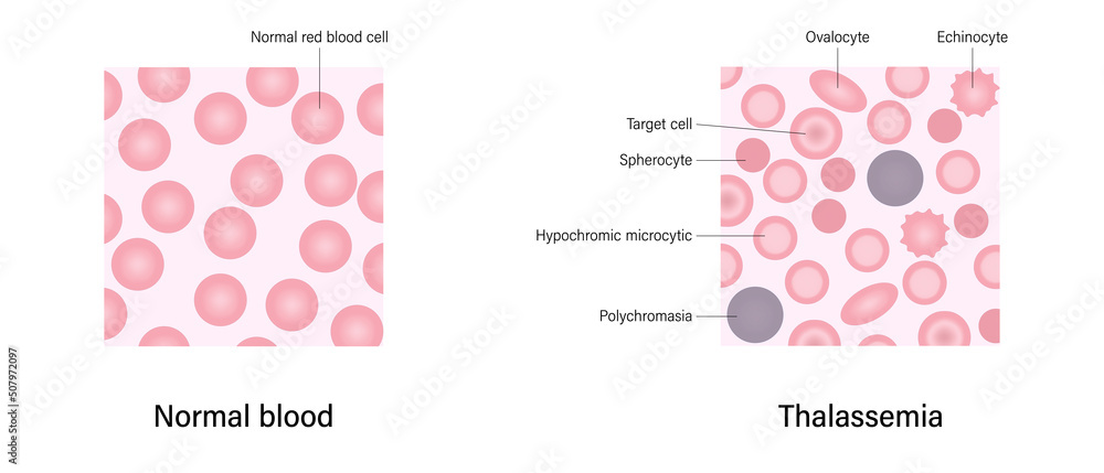 Thalassemia Blood Smear The Difference Of Thalassemia And Normal Blood