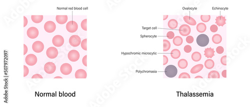 Thalassemia blood smear. The difference of Thalassemia and Normal blood.