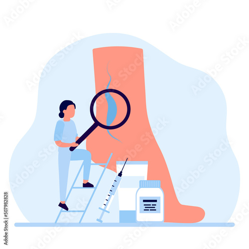 Varicose and vein thrombosis, treatment leg. Tiny Doctor with drugs and medical instruments medication foot with diseased veins. Examination blood vessels and veins, health care. Vector Illustration