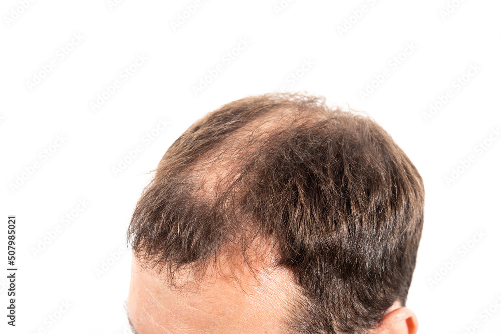 Close-up balding head of a young man on a white isolated background. Close-up balding head of a young man on a white isolated background.