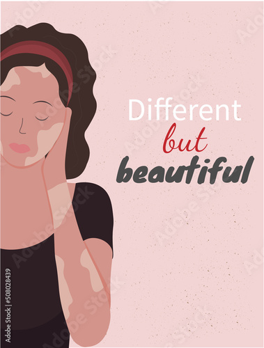 Portrait of young beautiful sad woman with vitiligi disease, world vitiligo day concept, support of people with vitiligo, flat vector illustration