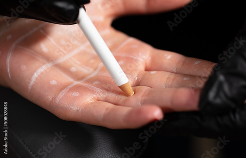 excessive sweating disease. Hyperhidrosis. Women's cosmetology, skin care.
