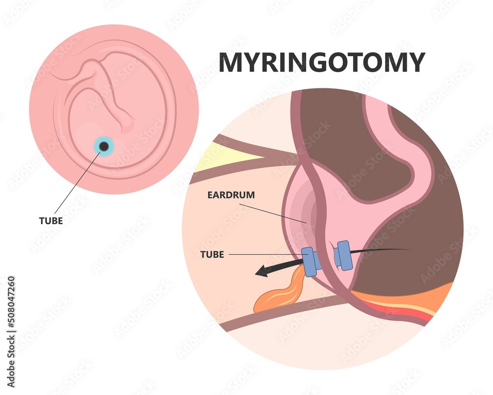 Perforated eardrum tube surgical drain Otitis media ear wax Hole repair
