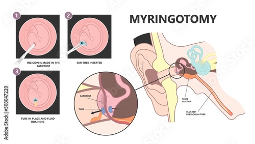 Perforated eardrum tube surgical drain Otitis media ear wax Hole repair sound canal tear pain pus bloody Hearing loss injury Middle fluid water Loud blasts microscopic acute bone cotton swab otoscopic