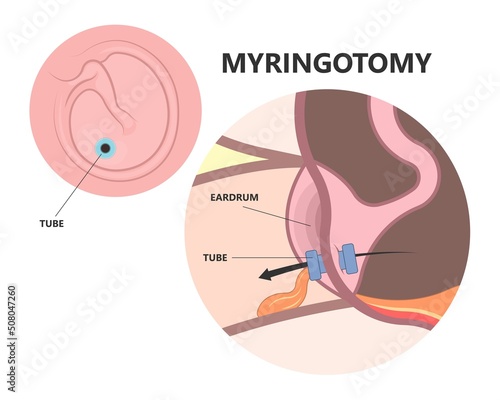 Perforated eardrum tube surgical drain Otitis media ear wax Hole repair sound canal tear pain pus bloody Hearing loss injury Middle fluid water Loud blasts microscopic acute bone cotton swab otoscopic