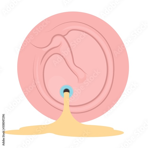 Perforated eardrum tube surgical drain Otitis media ear wax Hole repair sound canal tear pain pus bloody Hearing loss injury Middle fluid water Loud blasts microscopic acute bone cotton swab otoscopic