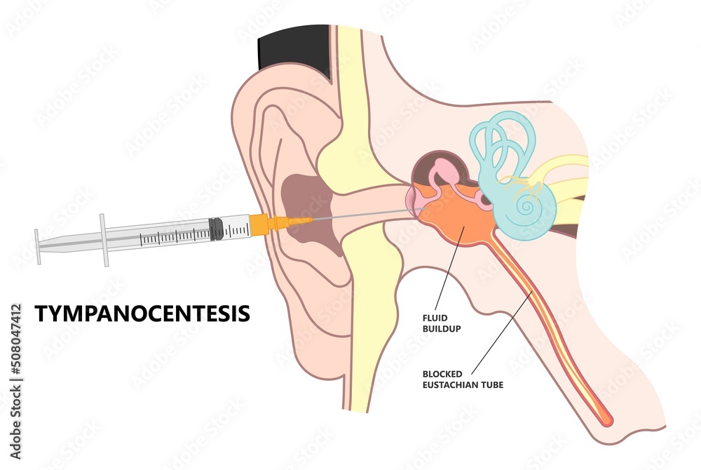 Perforated eardrum tube surgical drain Otitis media ear wax Hole repair