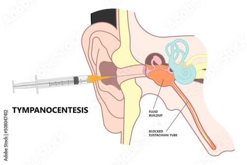 Perforated eardrum tube surgical drain Otitis media ear wax Hole repair sound canal tear pain pus bloody Hearing loss injury Middle fluid water Loud blasts microscopic acute bone cotton swab otoscopic