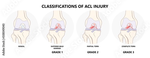 ACL injury knee tear torn Arthroscopy bone Pain swollen range of motion grade thighbone Rest Ice treat first aid heal photo