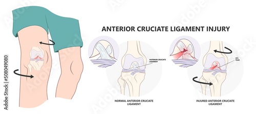 ACL injury knee tear torn Arthroscopy bone Pain swollen range of motion grade thighbone Rest Ice treat first aid heal