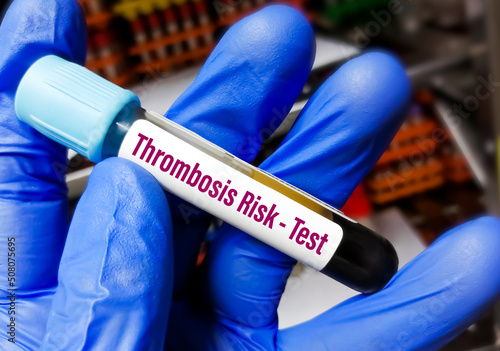 Doctor holding Blood tube for Thrombosis Risk factor test. Bleeding disorder. photo