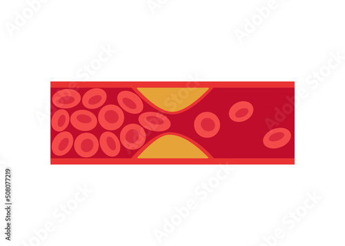 Deep vein thrombosis (DVT), artery and vein disease with fat cells, abnormally of blood vascular flow. Cholesterol in blocked in human blood vessel. Vector illustration