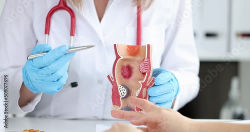 Doctor holds model of unhealthy lower rectum with inflamed vascular structures photo