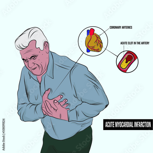 Acute myocardial infarction is an acute coronary syndrome. It is the sudden appearance of a picture of ischemic suffering