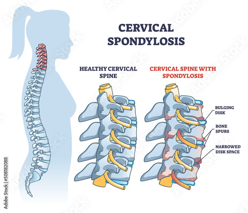 Cervical spondylosis problem compared with healthy spine outline diagram. Labeled educational scheme with human backbone disk bulging, bone spurs and narrowed space explanation vector illustration.