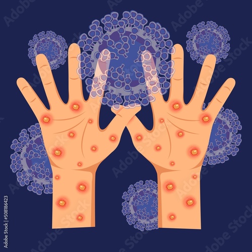 Human hands with monkeypox virus on the microscopic background of the virus. Vector illustration of monkeypox. Skin infection. Virus symptoms.