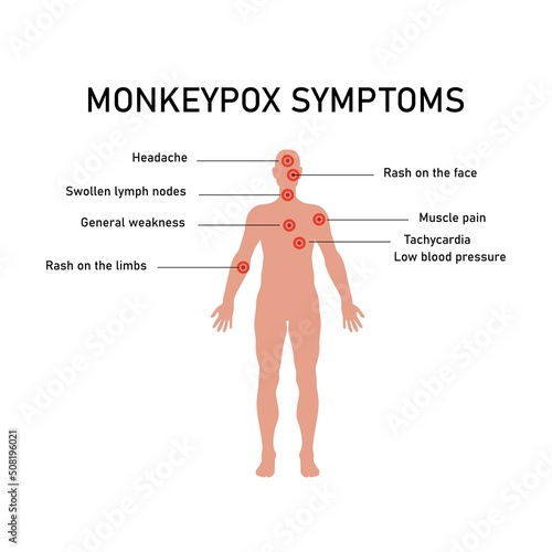 Monkeypox virus zoonotic viral disease that can infect human, nonhuman primates. Monkey pox. Vector illustration
