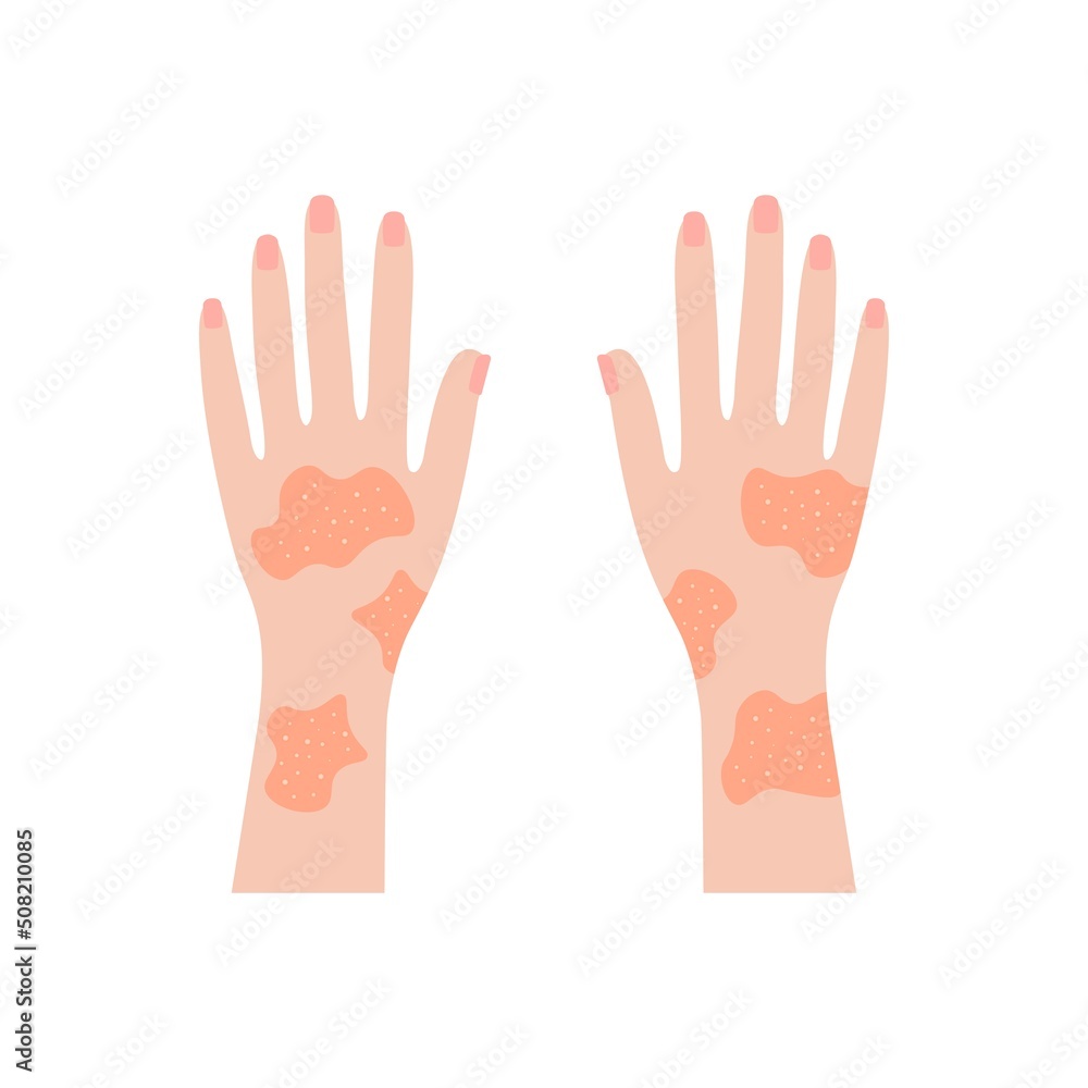 Hands covered with rash. Red psoriatic eruptions and inflamed eczema. Allergic urticaria problems and infectious vector smallpox infection Hands covered with rash. Red psoriatic eruptions and inflamed eczema. Allergic urticaria problems and infectious vector smallpox infection