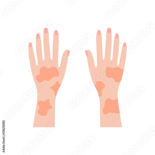 Hands covered with rash. Red psoriatic eruptions and inflamed eczema. Allergic urticaria problems and infectious vector smallpox infection